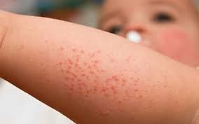 Những biểu hiện cảnh báo sốt xuất huyết ở trẻ em